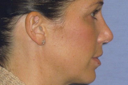 Rhinoplasty Before & After Patient #4614