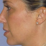Rhinoplasty Before & After Patient #4614