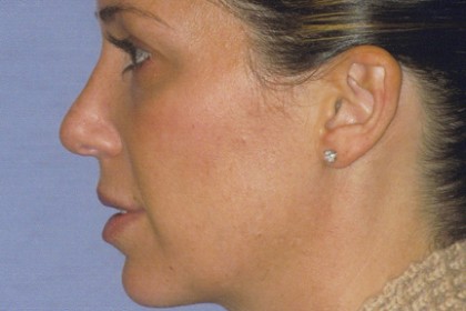 Rhinoplasty Before & After Patient #4614