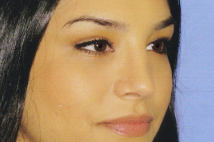 Rhinoplasty Before & After Patient #4619