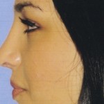 Rhinoplasty Before & After Patient #4619