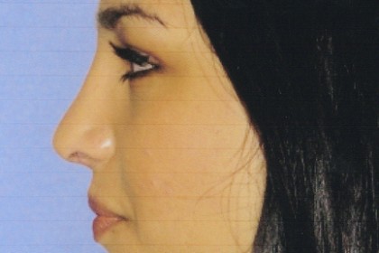 Rhinoplasty Before & After Patient #4619