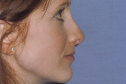Rhinoplasty Before & After Patient #4624