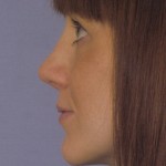 Rhinoplasty Before & After Patient #4624