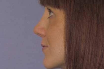 Rhinoplasty Before & After Patient #4624