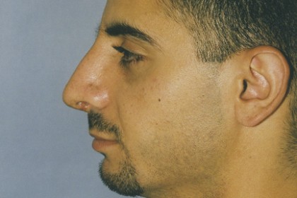 Rhinoplasty Before & After Patient #4633