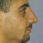 Rhinoplasty Before & After Patient #4633