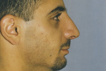 Rhinoplasty Before & After Patient #4633