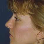 Rhinoplasty Before & After Patient #4589