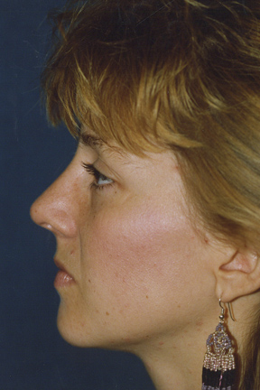 Rhinoplasty Before & After Patient #4589