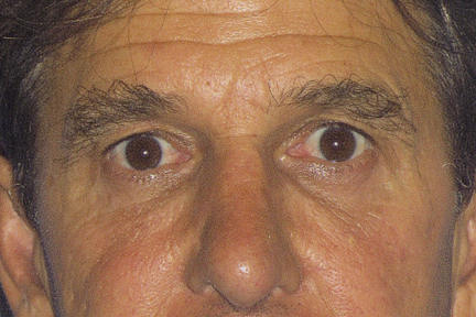 Rhinoplasty Before & After Patient #4598