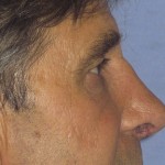 Rhinoplasty Before & After Patient #4598