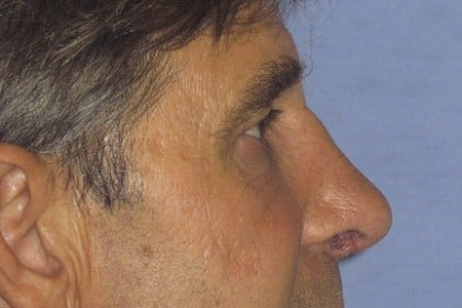 Rhinoplasty Before & After Patient #4598