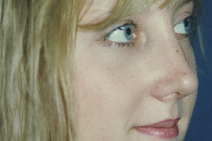 Rhinoplasty Before & After Patient #4603