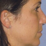 Rhinoplasty Before & After Patient #4614