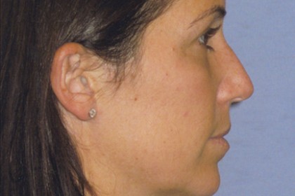 Rhinoplasty Before & After Patient #4614