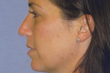 Rhinoplasty Before & After Patient #4614