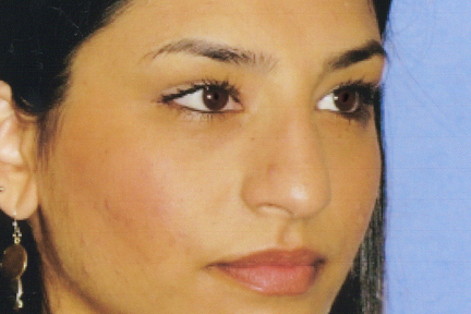 Rhinoplasty Before & After Patient #4619