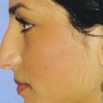 Rhinoplasty Before & After Patient #4619