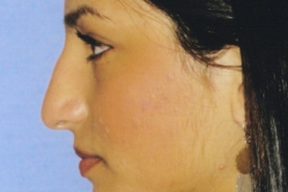 Rhinoplasty Before & After Patient #4619