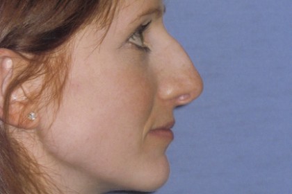 Rhinoplasty Before & After Patient #4624