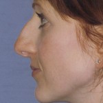 Rhinoplasty Before & After Patient #4624