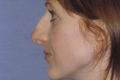 Rhinoplasty Before & After Patient #4624