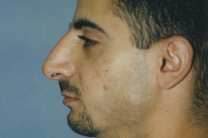 Rhinoplasty Before & After Patient #4633