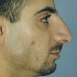 Rhinoplasty Before & After Patient #4633