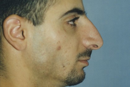 Rhinoplasty Before & After Patient #4633