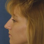 Rhinoplasty Before & After Patient #4589