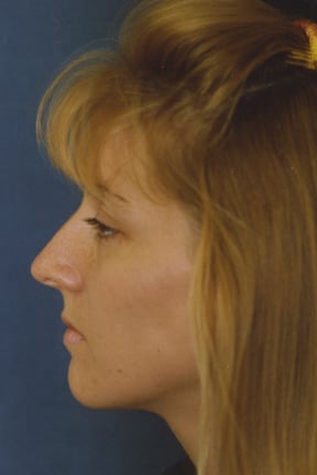 Rhinoplasty Before & After Patient #4589