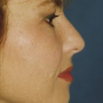Rhinoplasty Before & After Patient #4592