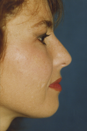 Rhinoplasty Before & After Patient #4592