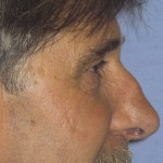 Rhinoplasty Before & After Patient #4598