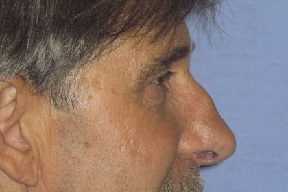 Rhinoplasty Before & After Patient #4598