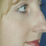Rhinoplasty Before & After Patient #4603