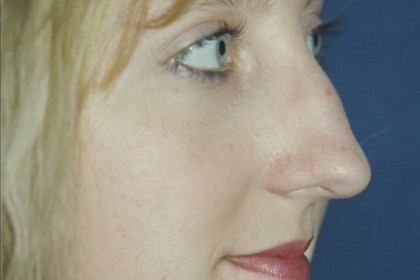 Rhinoplasty Before & After Patient #4603