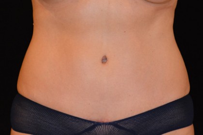 Tummy Tuck Before & After Patient #4890