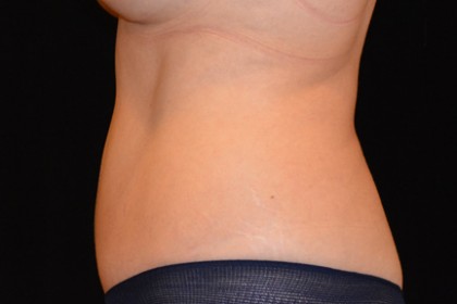 Tummy Tuck Before & After Patient #4890