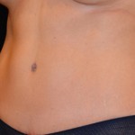 Tummy Tuck Before & After Patient #4890