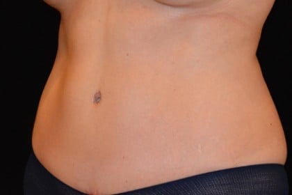 Tummy Tuck Before & After Patient #4890