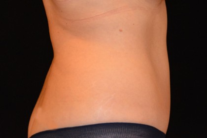 Tummy Tuck Before & After Patient #4890