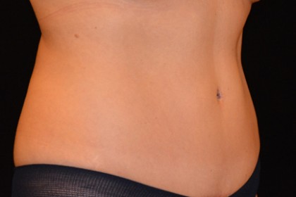 Tummy Tuck Before & After Patient #4890