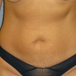 Tummy Tuck Before & After Patient #4890