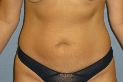 Tummy Tuck Before & After Patient #4890