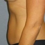 Tummy Tuck Before & After Patient #4890