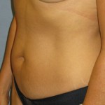 Tummy Tuck Before & After Patient #4890