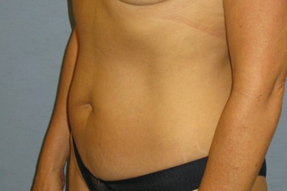 Tummy Tuck Before & After Patient #4890
