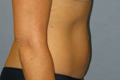 Tummy Tuck Before & After Patient #4890